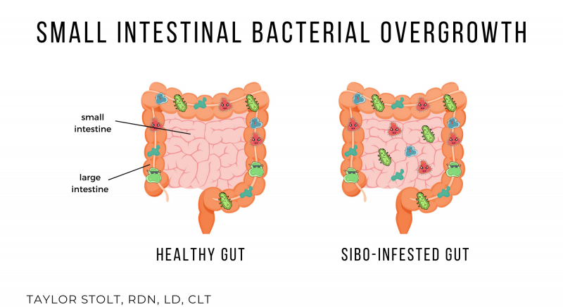 small intestinal bacterial overgrowth sibo