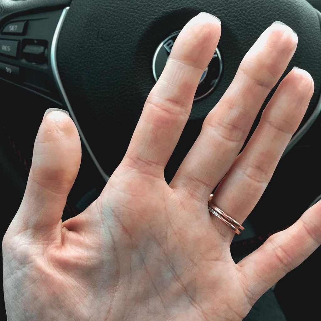 raynaud's on hands