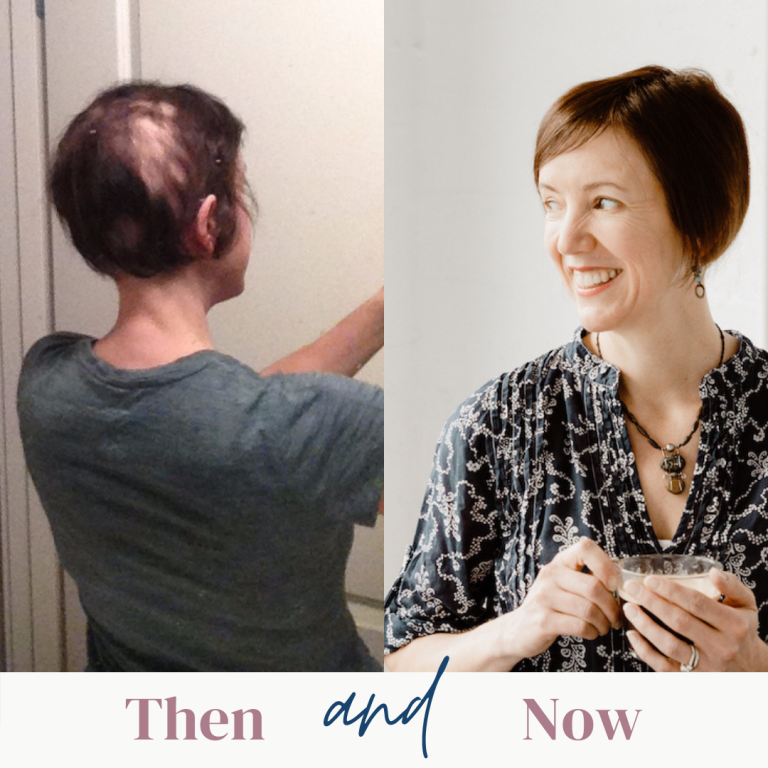 Alopecia Areata feature image