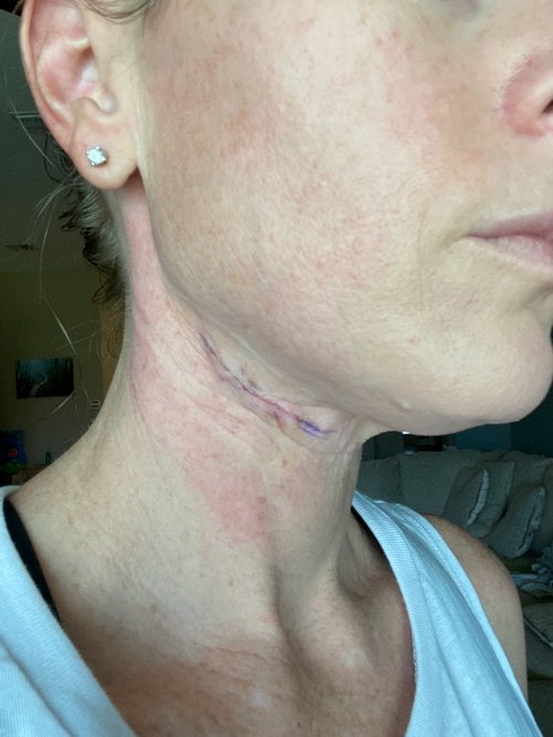 Possible skin cancer removal